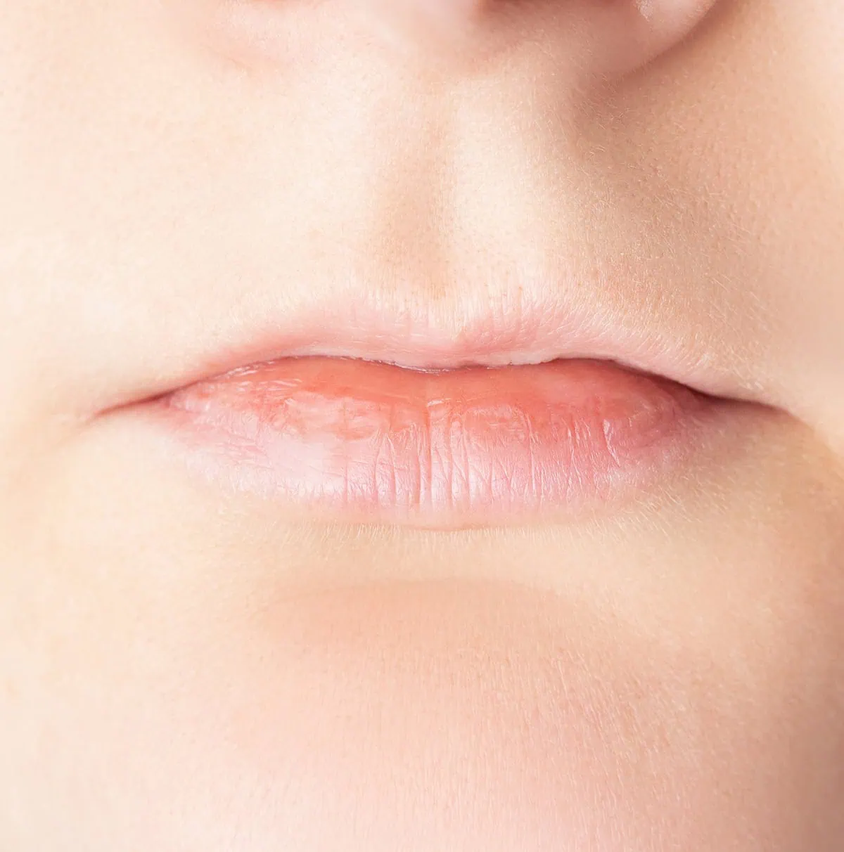 Before Lip Fillers Before Dermal filler treatment at Curate Medspa in Austin, TX